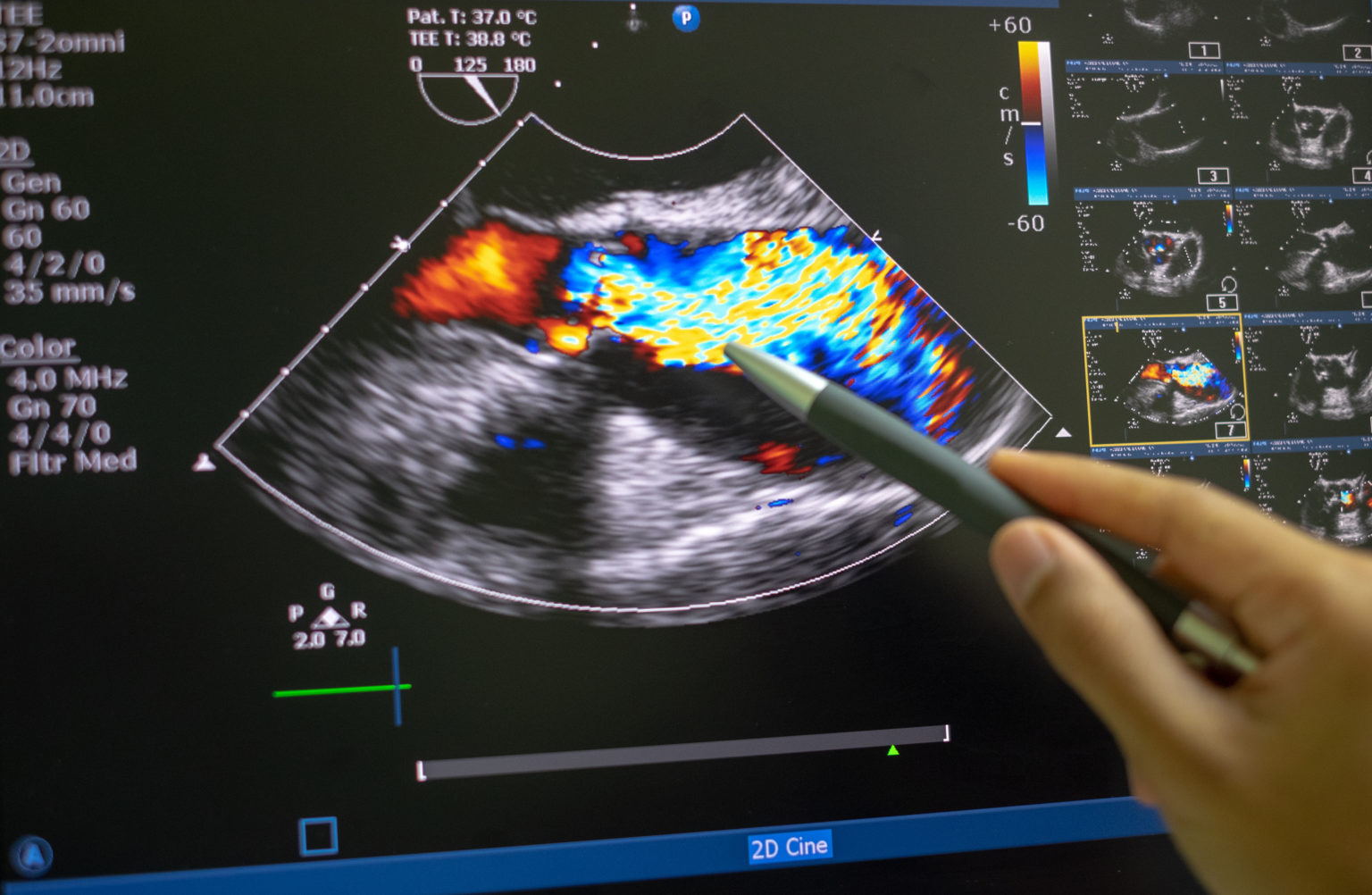 echocardiography-ultrasound-parker-university